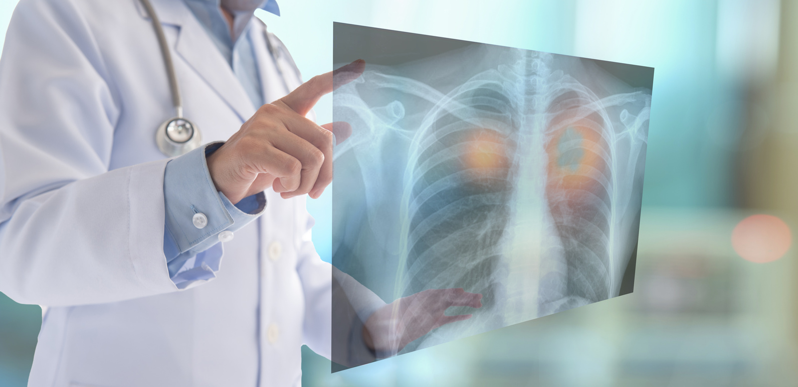 lung cancer x-ray