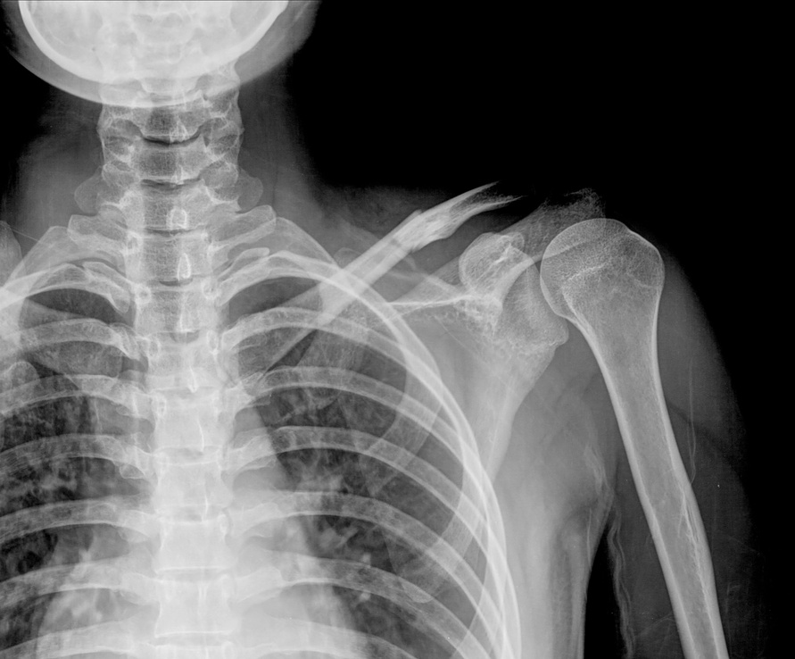 x-ray